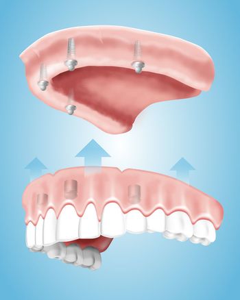 Implantate eignen sich hervorragend um Zahnprothesen oder Brücken zu stabilisieren